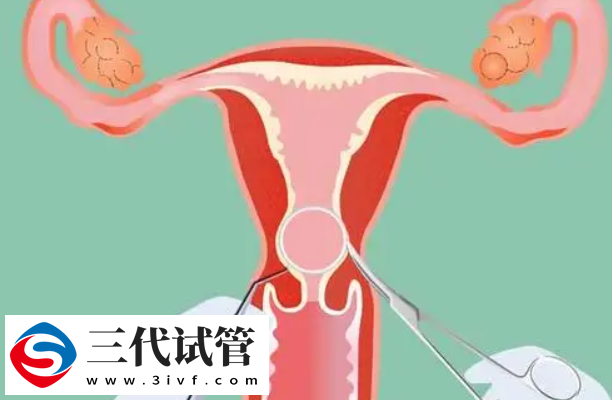 免费上环与自费有区别，材质、适用年龄都不同(图2)