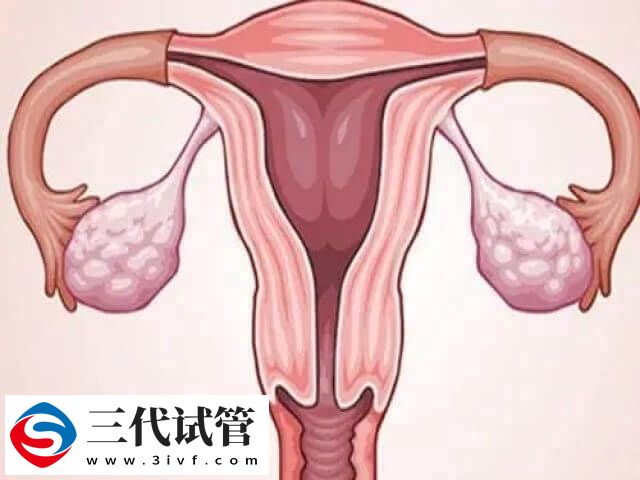 子宫疤痕憩室可不可以做试管婴儿(图1) 子宫疤痕憩室可不可以做试管婴儿(图1)