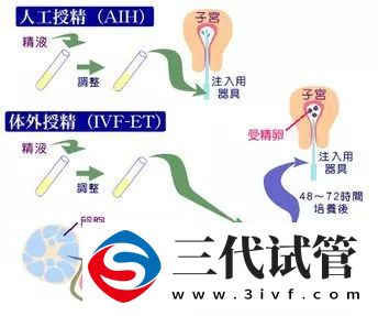 1代、2代、3代试管,有什么区别?哪个适合你?(图3) 1代、2代、3代试管,有什么区别?哪个适合你?(图3)