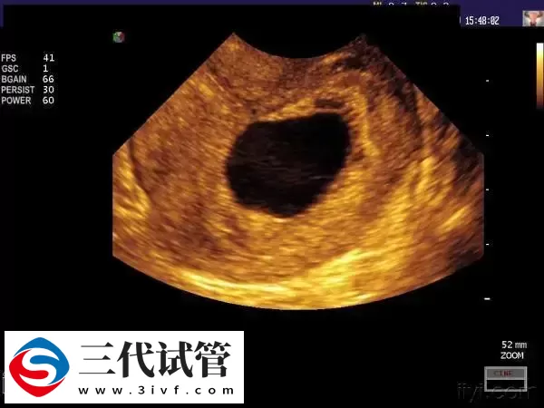 试管婴儿移植后孕囊偏左侧怎么回事(图1) 试管婴儿移植后孕囊偏左侧怎么回事(图1)