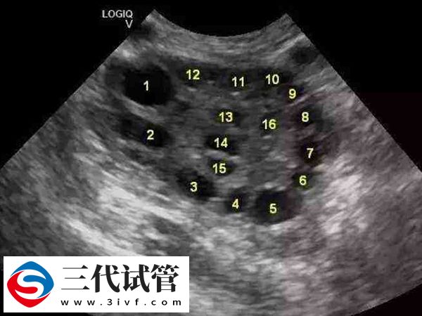 最佳取卵时间是什么时候(图1) 最佳取卵时间是什么时候(图1)