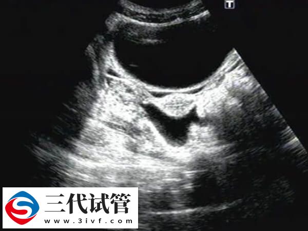 鲜胚移植后宫腔积液多久能吸收(图1)
