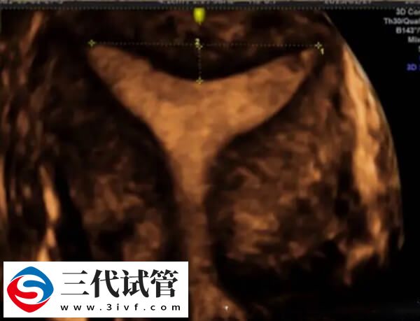 鲜胚移植后宫腔积液多久能吸收(图2)