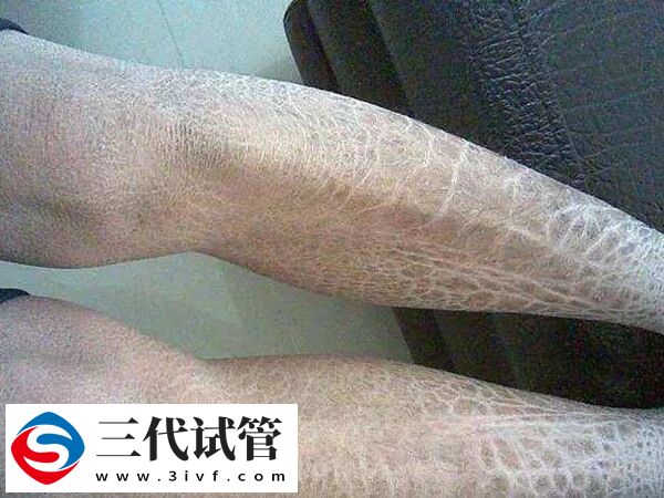 三代试管能筛查并阻隔鱼鳞病遗传吗？(图1)