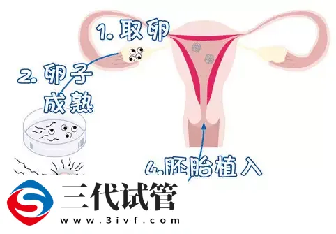 试管婴儿失败后最多能做几次,影响健康吗?(图1) 试管婴儿失败后最多能做几次,影响健康吗?(图1)