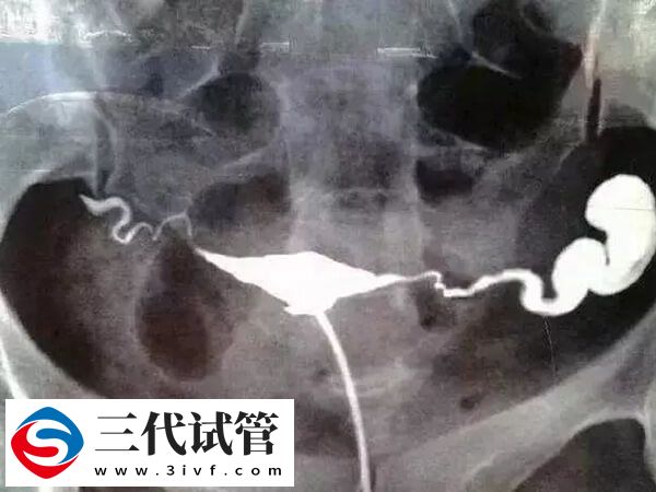 双侧输卵管梗阻怎么治疗